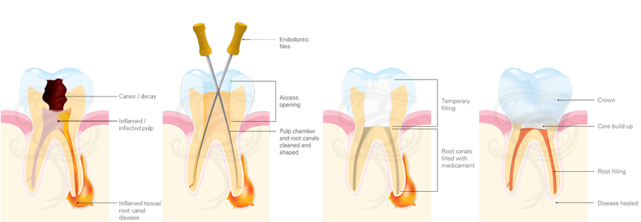 Root-Canal-Treatment